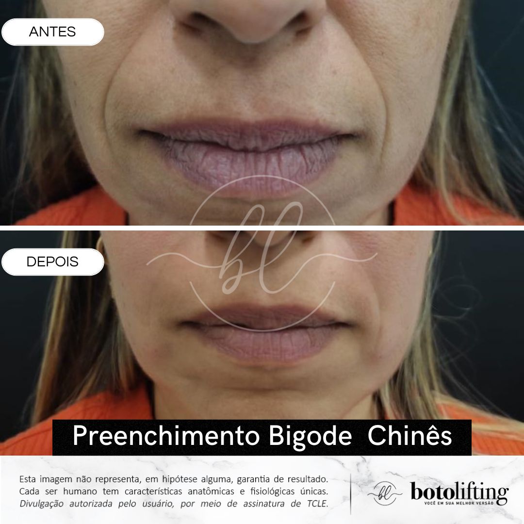 Preenchimento de Bigóde chinês Botolifting Jundiaí